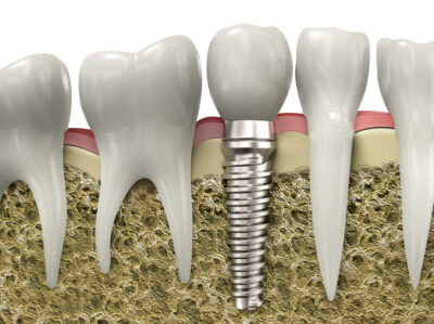 Dental implants are available from our Yuba City dentists.