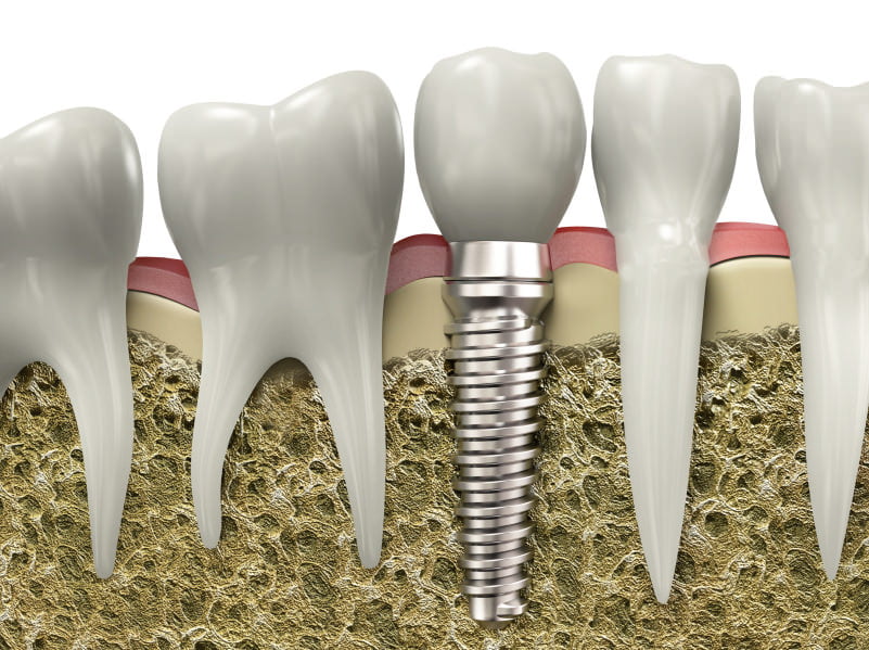 A Tooth Loss Solution