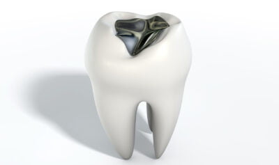 Amalgam Replacement