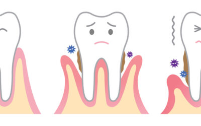 Root Cavities and Gum Disease