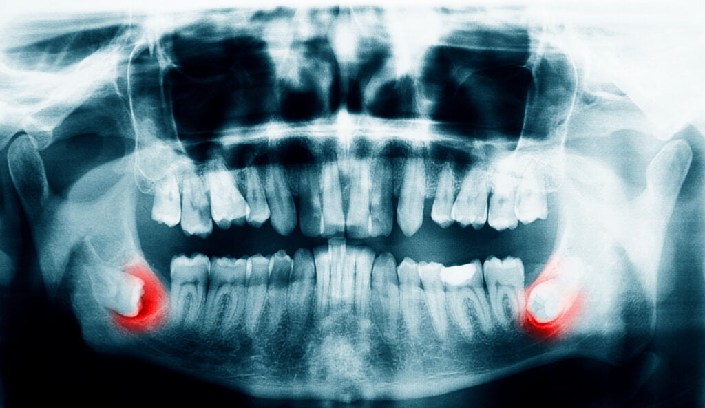 Benefits of Dental X-rays