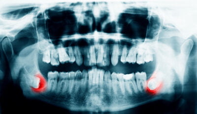 Wisdom Teeth Extraction