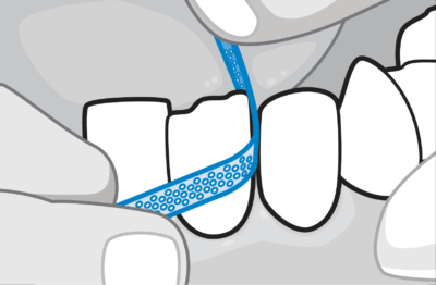 Interproximal Reduction