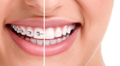 Braces - Yuba City Dentistry Group