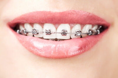 Metal Braces