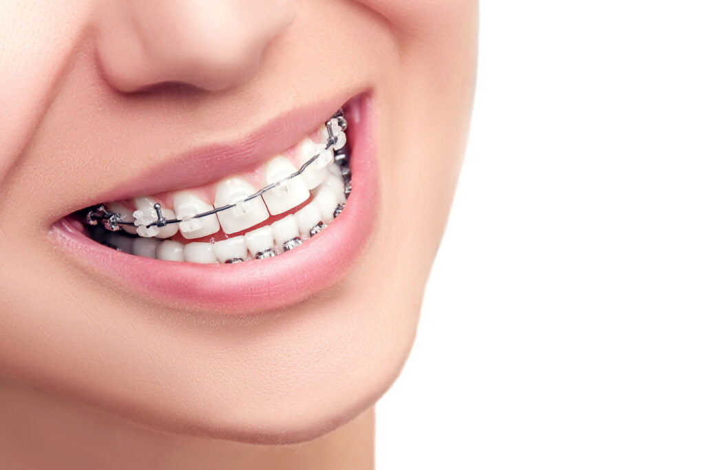 Tips for New Braces
