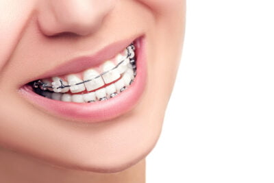 Clear Braces vs. Metal Braces, Frazer Dental Care, Dentist