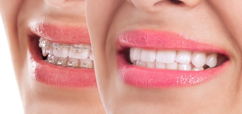 Braces or Invisalign?