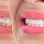 Before and after comparison of a person's smile: on the left, the teeth are adorned with clear braces with metal brackets, and on the right, the image shows the same smile post-orthodontic treatment, featuring straight, white teeth. The person's lips are painted with glossy pink lipstick, highlighting the cosmetic dental results. The split-screen format emphasizes the effectiveness of the braces in dental correction.