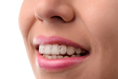 A young woman wears an clear aligner.