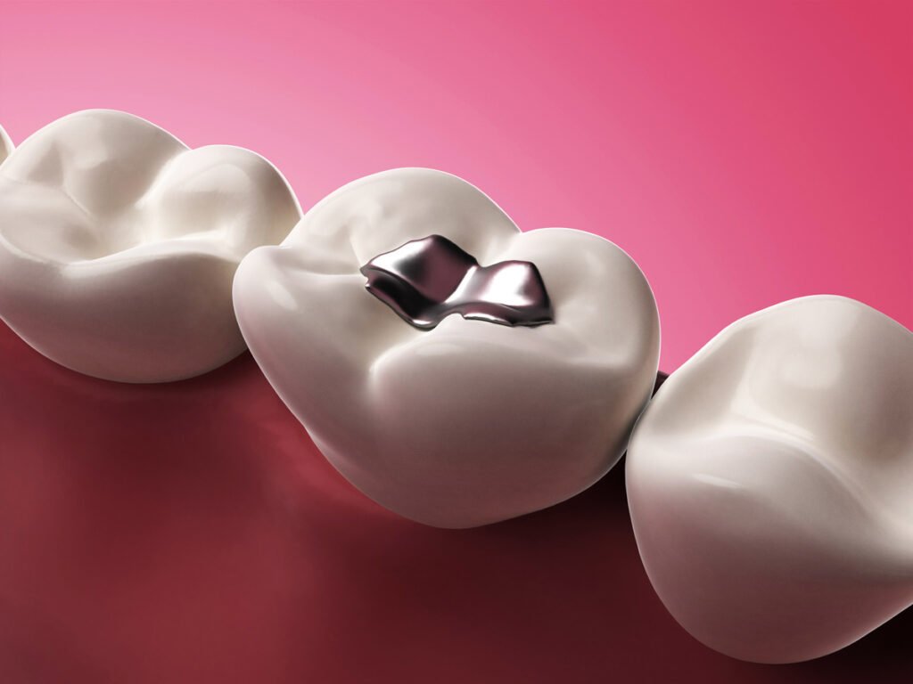 Should You Replace Your Fillings?