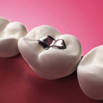An image of an amalgam filling represents the question of whether these should be replaced.