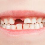 Teeth fall out as new ones come behind. Should you help it along?