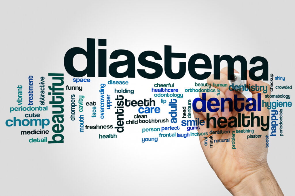 What is a Diastema?
