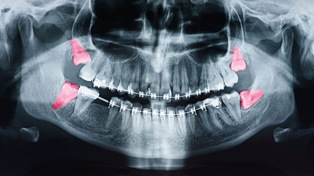 Seeking Wisdom About Teeth