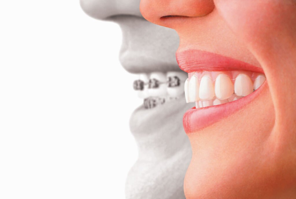 The Invisalign Experience for Adults