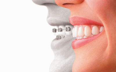 The Invisalign Experience for Adults