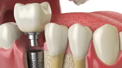 Anatomy of healthy teeth and tooth dental implant in human denturra.