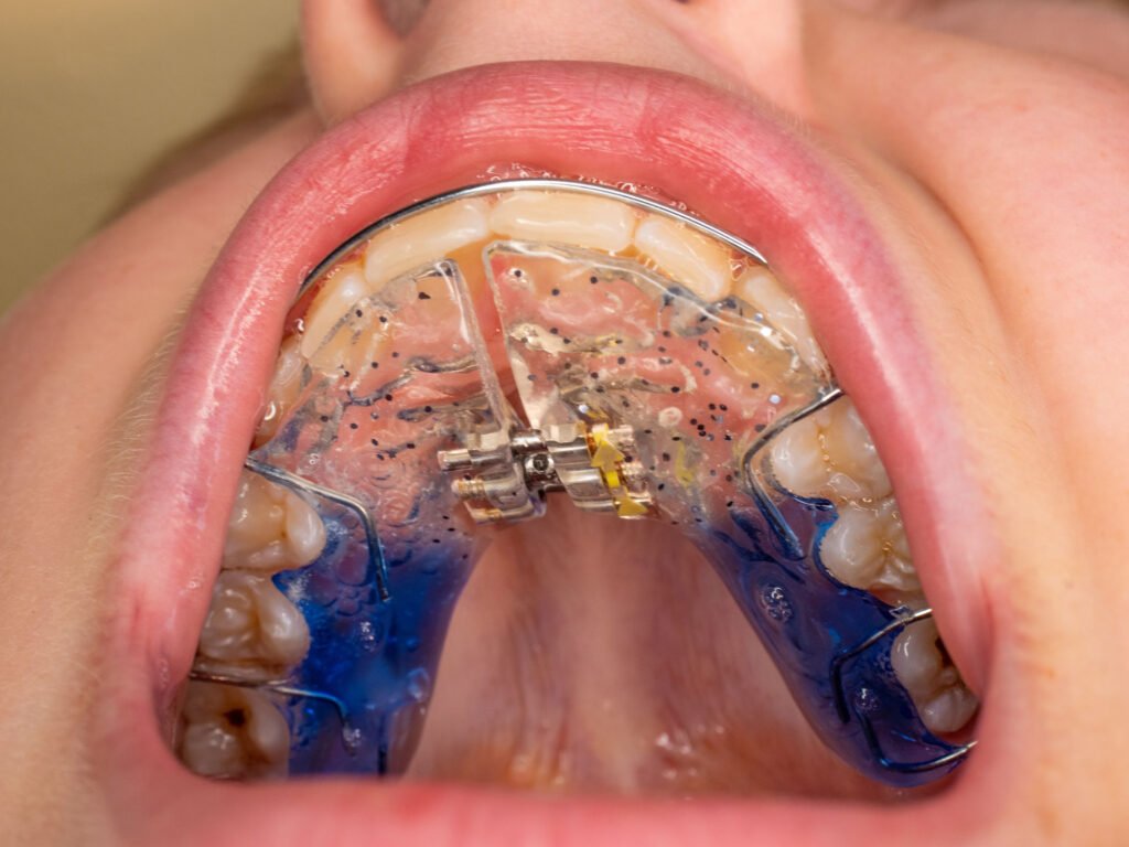 Understanding Palate Expanders